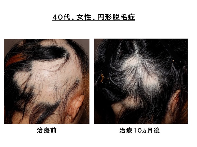 円形脱毛症　病院